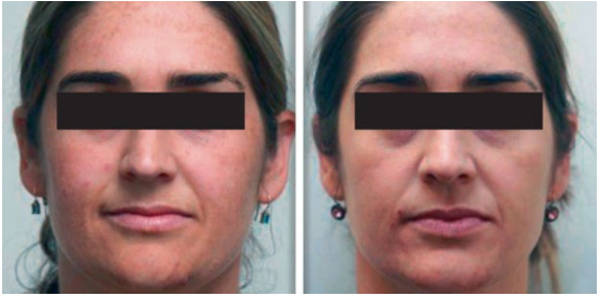 Hệ thống Pensilia Beauty Clinic áp dụng Laser Fotona Starwalker MaQX vào điều trị các bệnh da liễu thẩm mỹ - 4