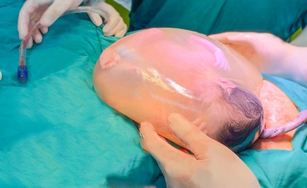 Mổ đẻ cho mẹ Thanh Hóa, bác sĩ phải amp;#34;nịnhamp;#34; em bé ra, hình ảnh sau đó đẹp tuyệt vời - 1