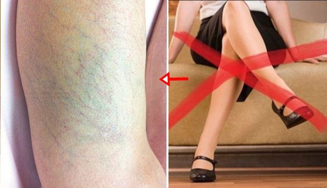 Nữ siêu mẫu vì thường xuyên ngồi kiểu này khiến cô bị gù lưng, giãn tĩnh mạch, viêm âm đạo - 3