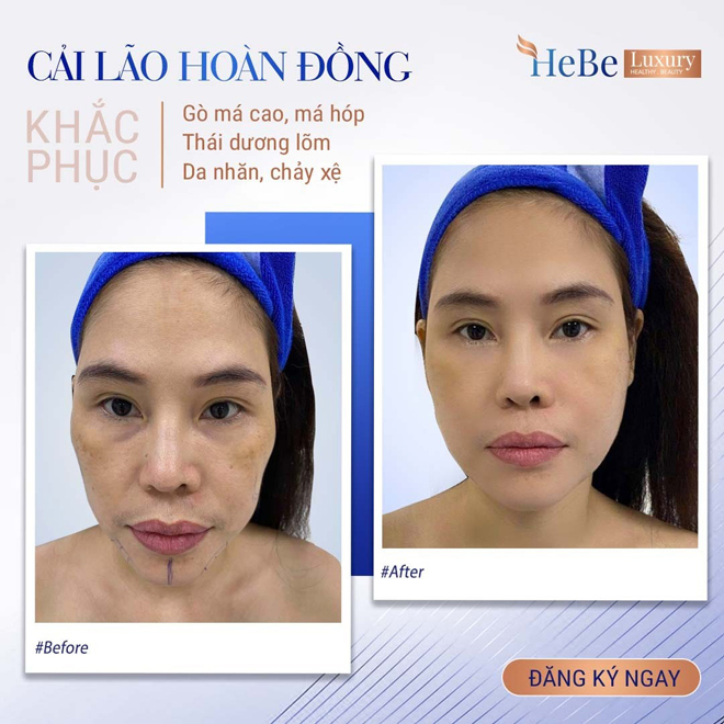 Bật mí về công nghệ “Cải lão hoàn đồng” khắc phục má hóp, gò má cao - 1
