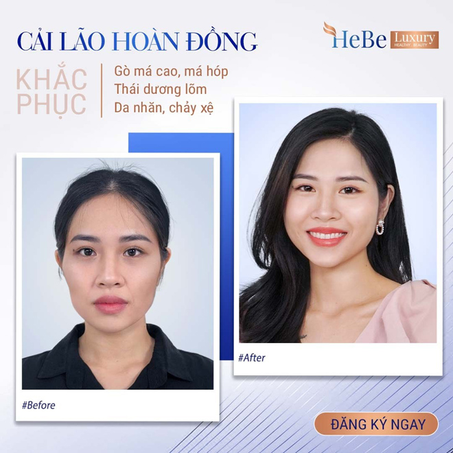 Bật mí về công nghệ “Cải lão hoàn đồng” khắc phục má hóp, gò má cao - 3