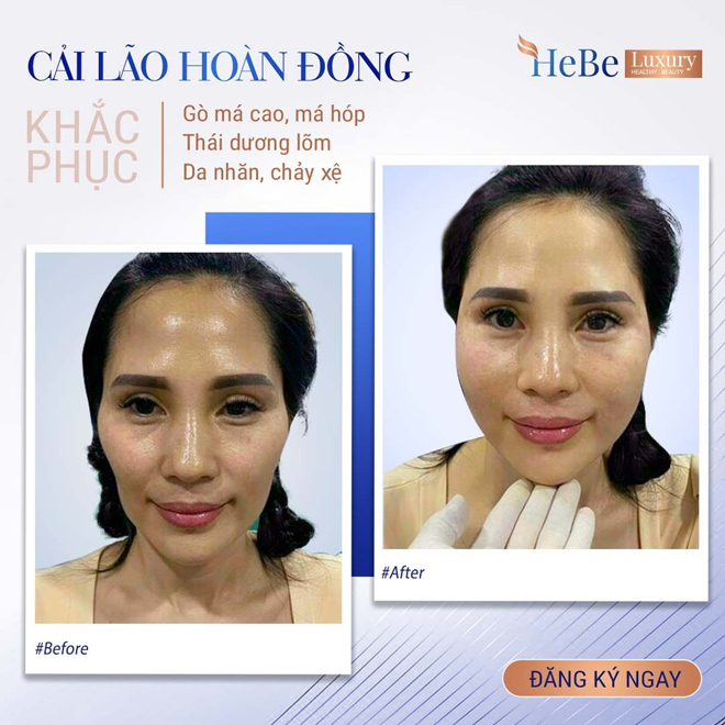 Bật mí về công nghệ “Cải lão hoàn đồng” khắc phục má hóp, gò má cao - 4