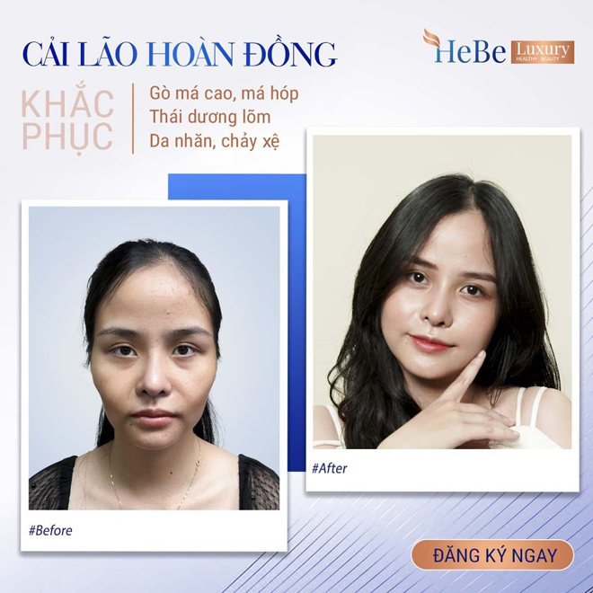 Bật mí về công nghệ “Cải lão hoàn đồng” khắc phục má hóp, gò má cao - 5