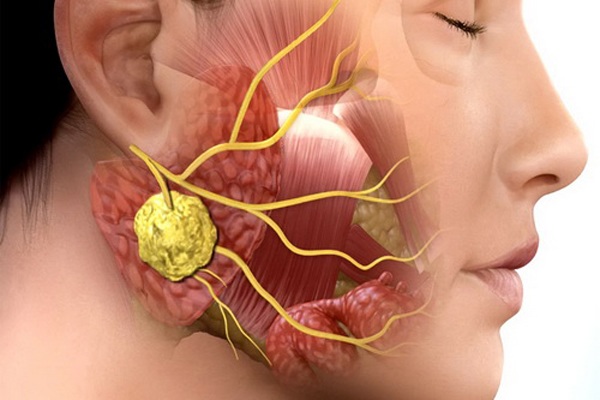 Bệnh khiến thí sinh hóa thân Hà Hồ trong Gương Mặt Thân Quen bị amp;#34;ănamp;#34; xương hàm có nguy hiểm? - 6
