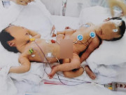 Tin tức - Bé gái duy nhất sống sót sau ca phẫu thuật tách rời vì dính liền chị gái giờ ra sao?
