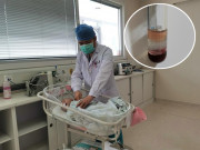 Sức khỏe - Bé 2 tháng tuổi xuất hiện "máu sữa" vì cha mẹ thương con, pha sữa bột quá đặc