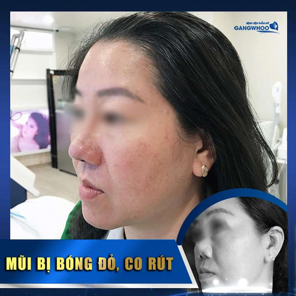 Bệnh viện thẩm mỹ Gangwhoo – địa điểm sửa mũi hỏng uy tín tại TP. Hồ Chí Minh - 2