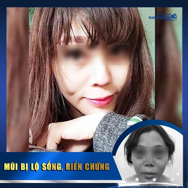 Bệnh viện thẩm mỹ Gangwhoo – địa điểm sửa mũi hỏng uy tín tại TP. Hồ Chí Minh - 3