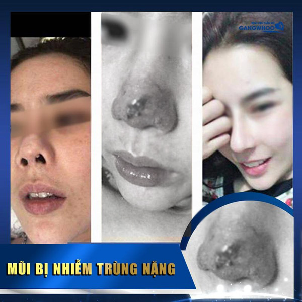 Bệnh viện thẩm mỹ Gangwhoo – địa điểm sửa mũi hỏng uy tín tại TP. Hồ Chí Minh - 4