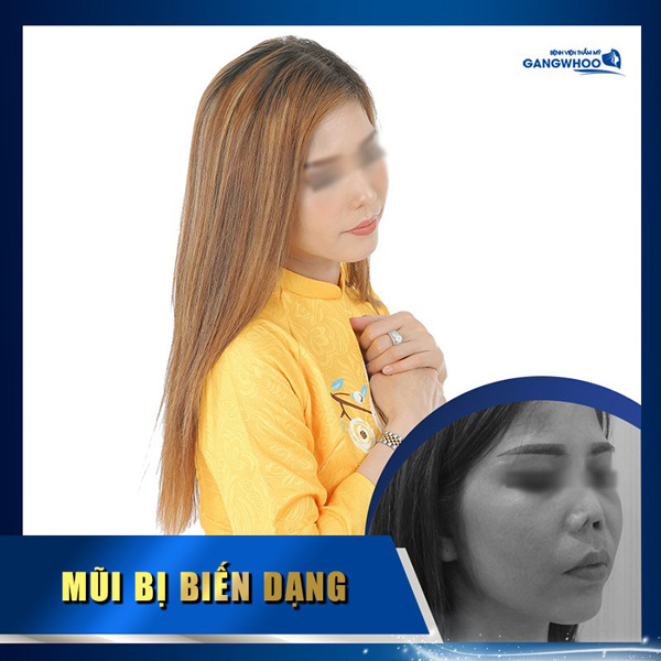 Bệnh viện thẩm mỹ Gangwhoo – địa điểm sửa mũi hỏng uy tín tại TP. Hồ Chí Minh - 5