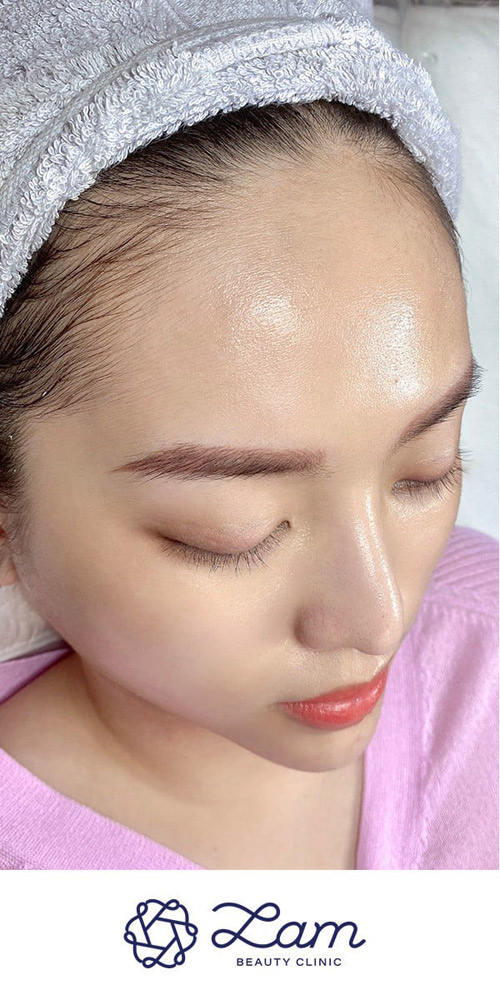 Thu nhỏ lỗ chân lông dễ dàng tại Lam Beauty Clinic - 2