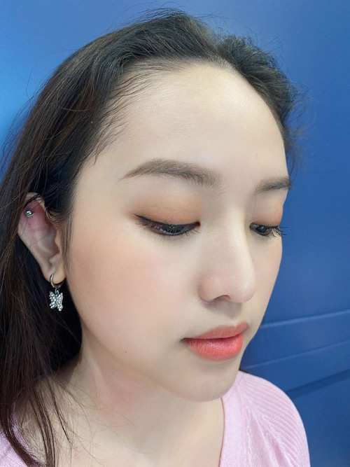 Thu nhỏ lỗ chân lông dễ dàng tại Lam Beauty Clinic - 4