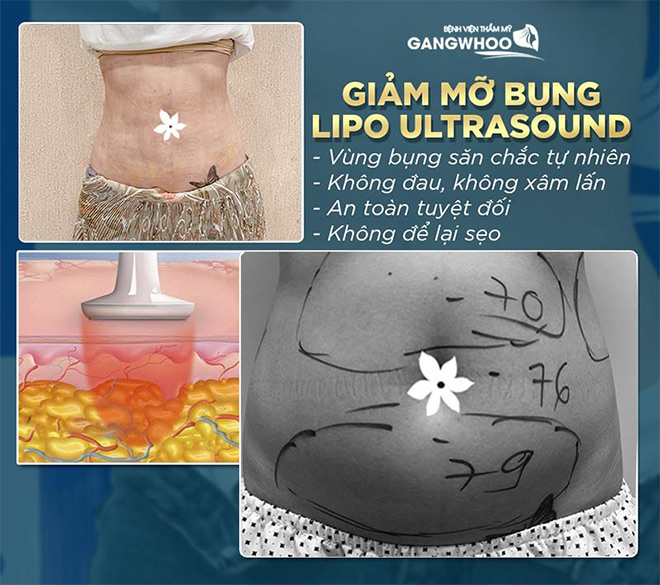 Lấy lại dáng thon chỉ sau 60 phút mà không cần phẫu thuật tại Bệnh viện thẩm mỹ GangWhoo - 1