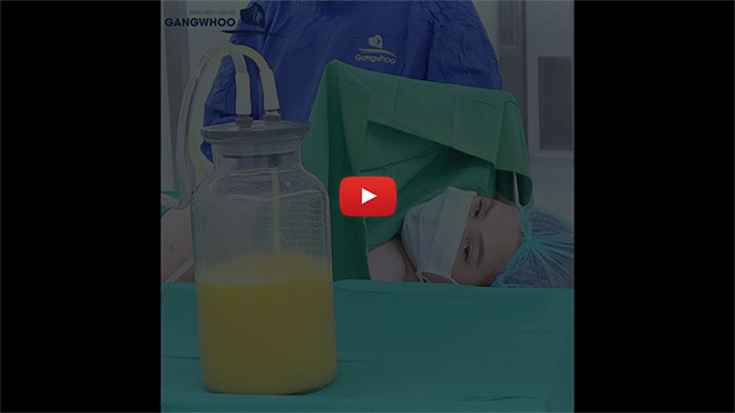 Lấy lại dáng thon chỉ sau 60 phút mà không cần phẫu thuật tại Bệnh viện thẩm mỹ GangWhoo - 3