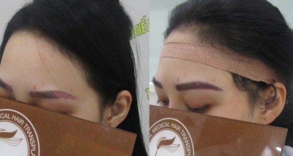 Phun xăm lông mày đã “xưa” rồi, cấy lông mày mới là phương pháp làm đẹp được ưa chuộng - 1