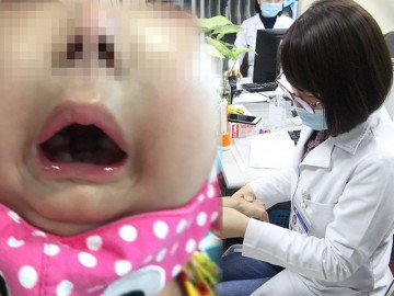 Bé 6 tuổi mang khuôn mặt người già, tóc rụng hết vì bệnh hiếm, Việt Nam chỉ có 1 ca