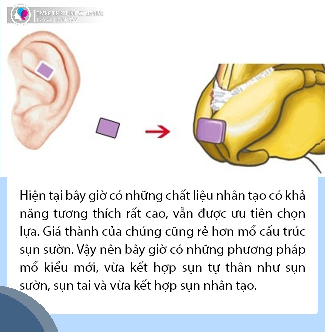 Sự thật không phải ai cũng tỏ: Nâng mũi quyết định chỉ 1% ở chất liệu - 2