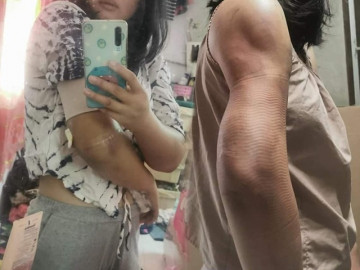 Bác sĩ nói gì về vụ đi hút mỡ tay nhận về cái kết biến dạng như teo cơ Delta