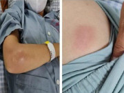 Sức khỏe - Sưng đau “vòng một”, cô gái Tuyên Quang đi cấp cứu phát hiện “vi khuẩn ăn thịt người” tấn công