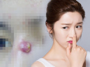 Làm đẹp - Nâng mũi xong về mụn nổi ầm ầm, chị em bình tĩnh đọc kĩ bài viết này