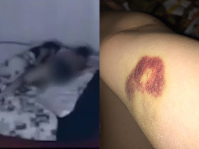 Đi dự tiệc, cô gái tỉnh dậy trong tình trạng bầm tím, hơn 1 năm sau biết sự thật sốc