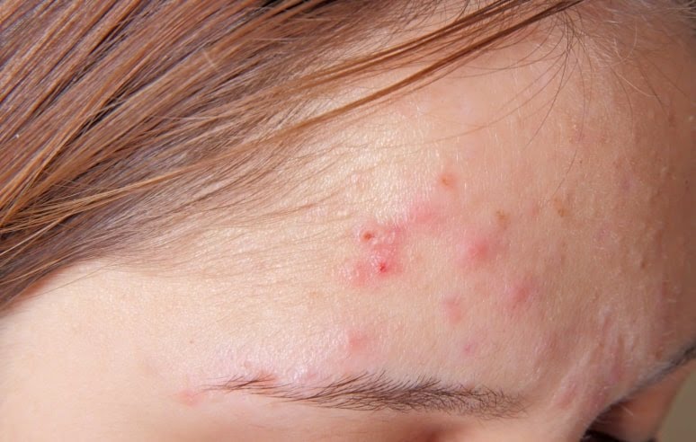  Mụn sẽ hay xuất hiện ở vùng trán hay má, còn nếu mụn ở vùng phẫu thuật nâng mũi (sống mũi, đầu mũi hay trong lỗ mũi) thì phải cẩn trọng, vì có thể là ổ viêm sau nâng mũi với dấu hiệu khởi phát là mụn.