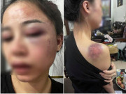 Tin tức - Truy tìm người chồng bị vợ tố bạo hành cả đêm, dùng gậy sắt đánh tới biến dạng khuôn mặt