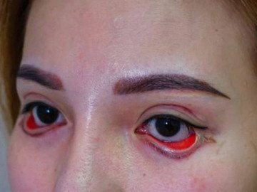 Cắt mí thành 'đôi mắt quỷ', cô gái trẻ bị cho thôi việc