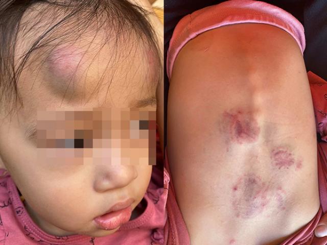 Tin tức 24h: Diễn biến mới nhất vụ bé gái 22 tháng tuổi bị bạn đánh dã man trong lớp