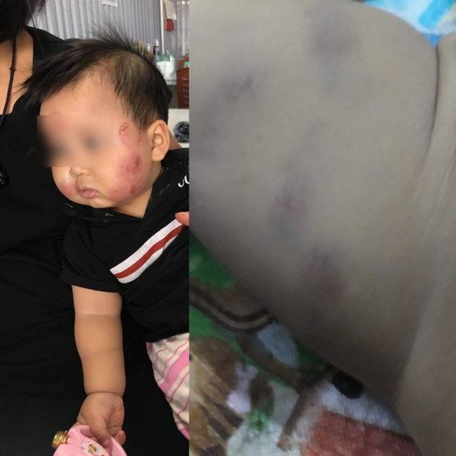 Những vết bầm tím trên người bé N.M năm 2018.
