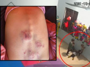 Tin tức - Bé 20 tháng bị đánh dã man ở Bắc Giang: Trường từng để trẻ 1 tuổi bầm tím đầy người