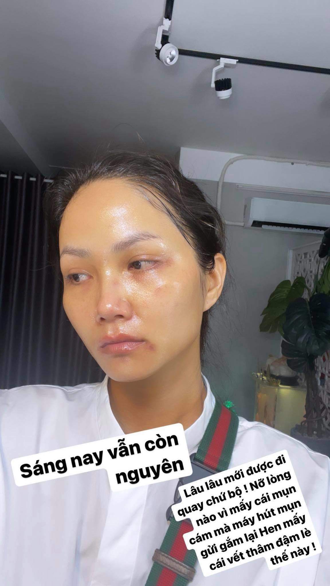 H’Hen Niê xuất hiện với gương mặt bầm dập, skincare kiểu gì mà hỏng luôn mặt tiền - 3