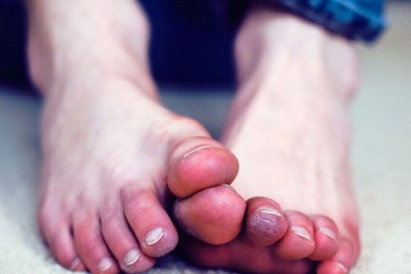 Việc không bảo vệ đôi chân khi trời lạnh sẽ gây ra nhiều hệ lụy với sức khỏe.