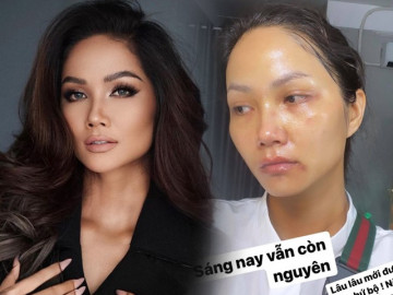 H’Hen Niê xuất hiện với gương mặt bầm dập, skincare kiểu gì mà hỏng luôn mặt tiền