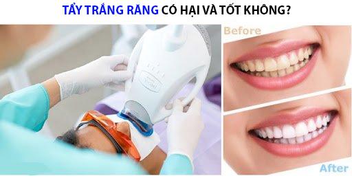 Tẩy trắng răng có hại gì với sức khỏe và những đối tượng không nên tẩy - 6