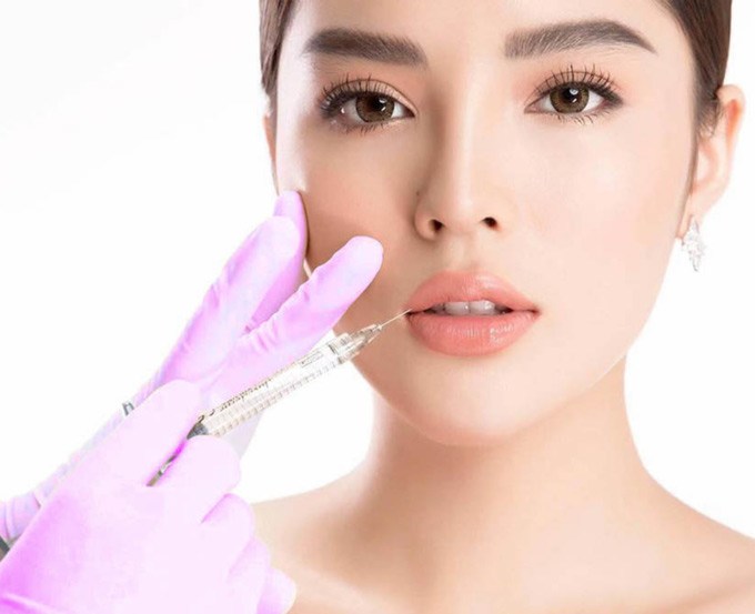 Phương pháp này thực hiện rất nhanh chóng, hạn chế xâm lấn và hiệu quả có thể duy trì từ 18 – 24 tháng nên được chị em tin dùng.