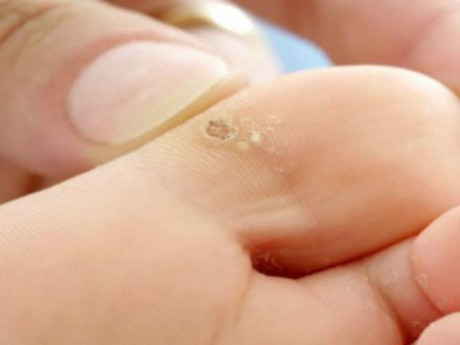 Cách trị mụn cóc bằng nguyên liệu tự nhiên an toàn hiệu quả