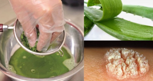Cách trị mụn cóc bằng nguyên liệu tự nhiên an toàn hiệu quả - 6