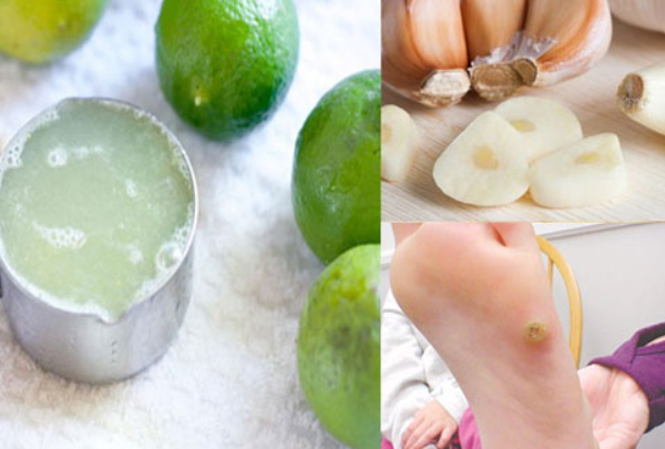 Cách trị mụn cóc bằng nguyên liệu tự nhiên an toàn hiệu quả - 4