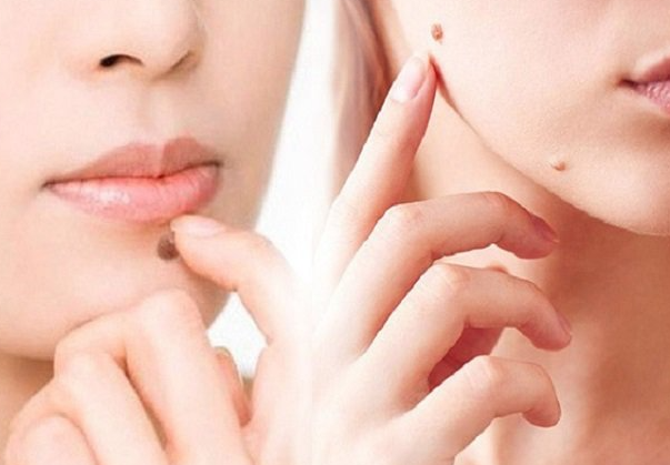 Có thể tẩy nốt ruồi lành tính