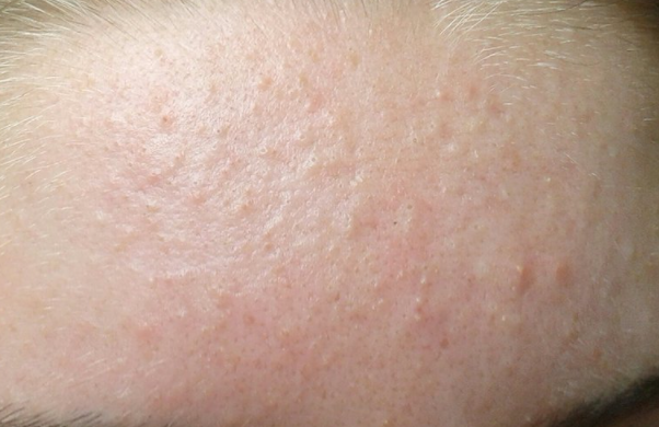 Mụn ẩn là những nốt mụn sần ẩn sâu dưới da