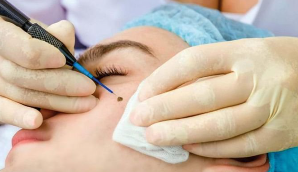 Đốt nốt ruồi lớn