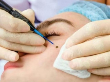 Cách tẩy nốt ruồi an toàn và hướng dẫn chăm sóc sau tẩy tại nhà