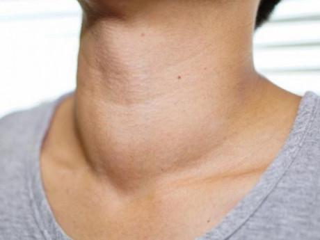 Bệnh cường giáp nên ăn gì và kiêng ăn gì?