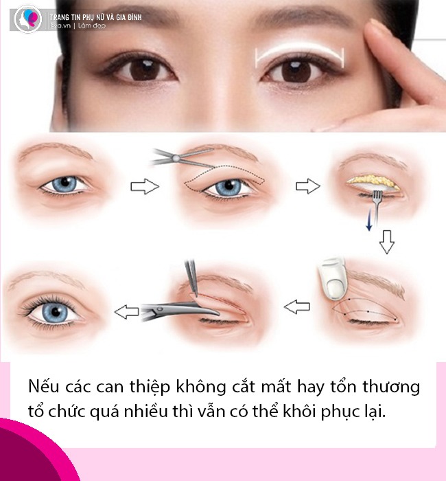 Bất ngờ với tin Thúy Vi dao kéo lần thứ n, nhan sắc làm đi làm lại liệu còn đẹp? - 5