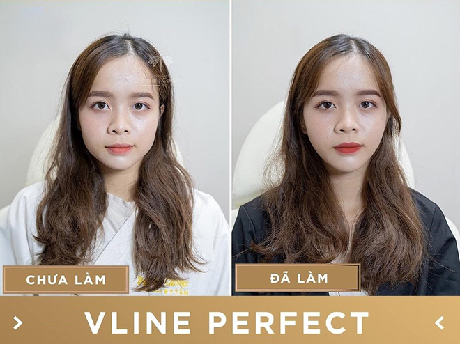 Vì sao công nghệ gọn hàm bằng máy Vline Perfect ngày càng được ưa chuộng - 3