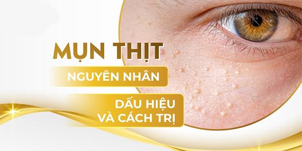 11 Cách trị mụn thịt tận gốc tại nhà an toàn hiệu quả nhanh nhất - 2