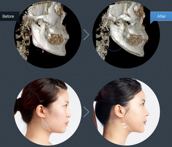 Phương pháp này thực hiện phẫu thuật ngoại khoa cắt gọt cằm