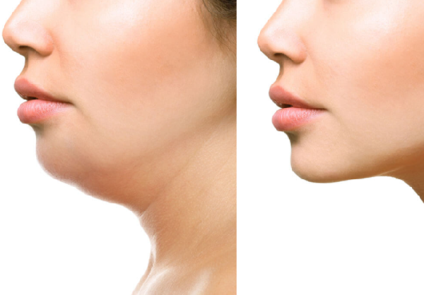 Hiệu quả thon gọn cằm