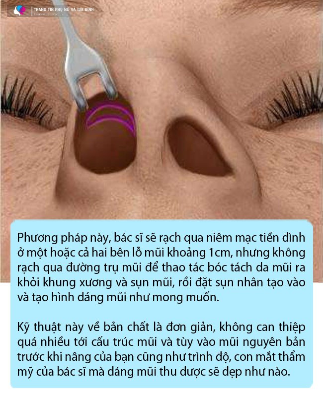 Công nghệ nâng mũi giờ đã khác, ai đang có ý định thẩm mỹ, đọc ngay bài viết này! - 3